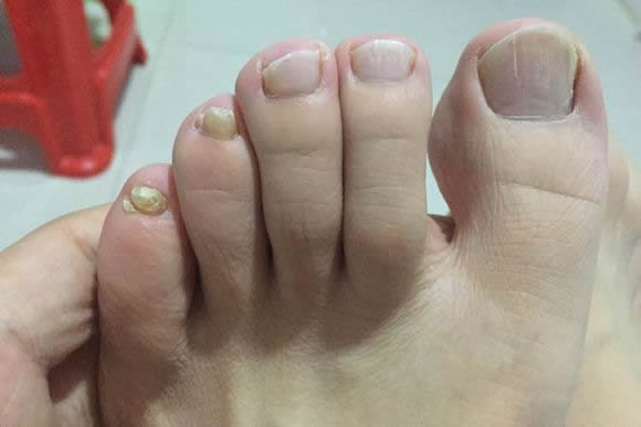 赣州南康区看灰指甲医院