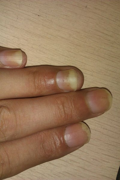 南康区治灰指甲的皮肤科哪个医院好